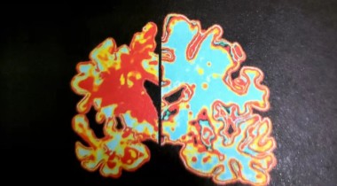 不老莓潜在的药理活性（一）——慢性疾病的基础抗炎作用