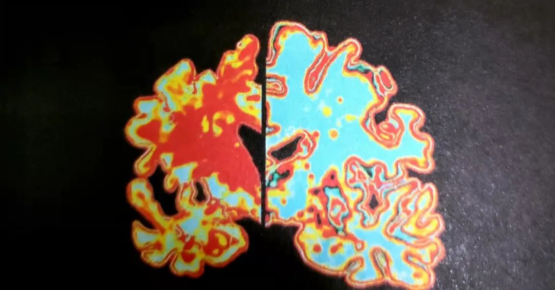 不老莓潜在的药理活性(一)——慢性疾病的基础抗炎作用 不老莓潜在的药理活性(一)——慢性疾病的基础抗炎作用